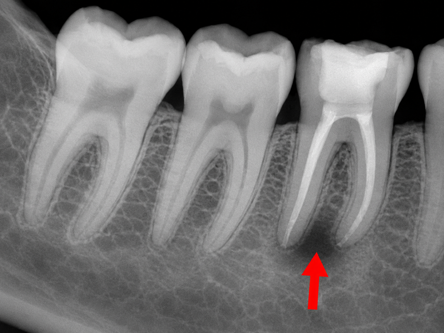 Radiografía periapical